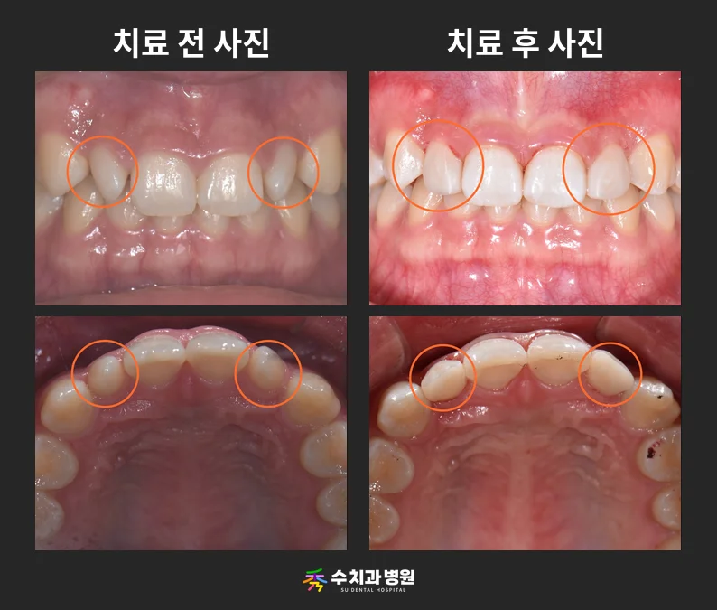📸 치료 전후 비교 사진