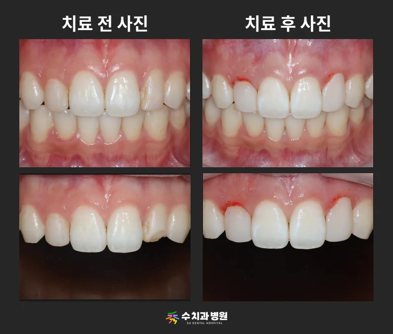 📸 치료 전후 비교 사진