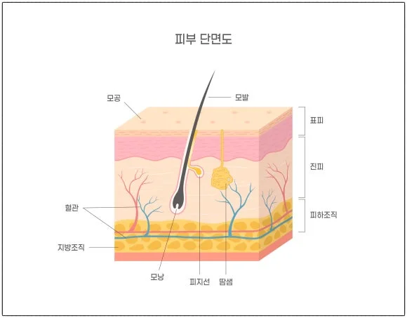 레이저 리프팅 시술 원리를 설명하는 장비 이미지