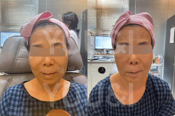 고주파 리프팅과 실리프팅 시술을 비교 설명하는 상담 장면