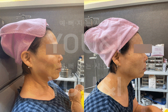 실리프팅 시술 준비 과정에서 마취를 진행하는 모습