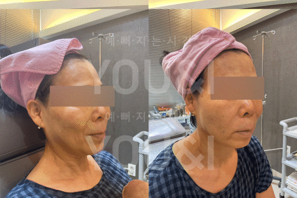 실을 이용해 팔자주름 부위를 리프팅하는 시술 장면