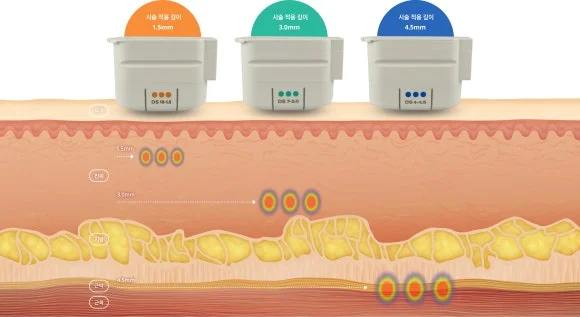 피부 깊이별 리프팅 원리를 설명하는 이미지