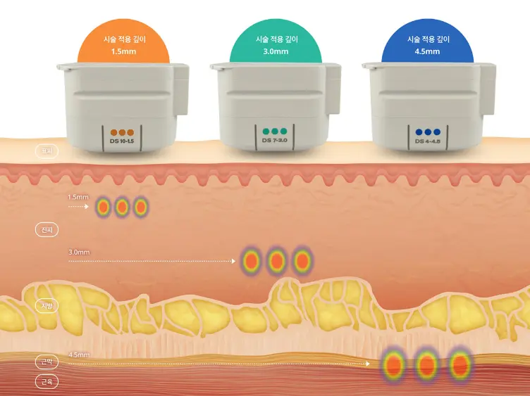 울쎄라 원리, 콜라겐 변성과 수축 유도
