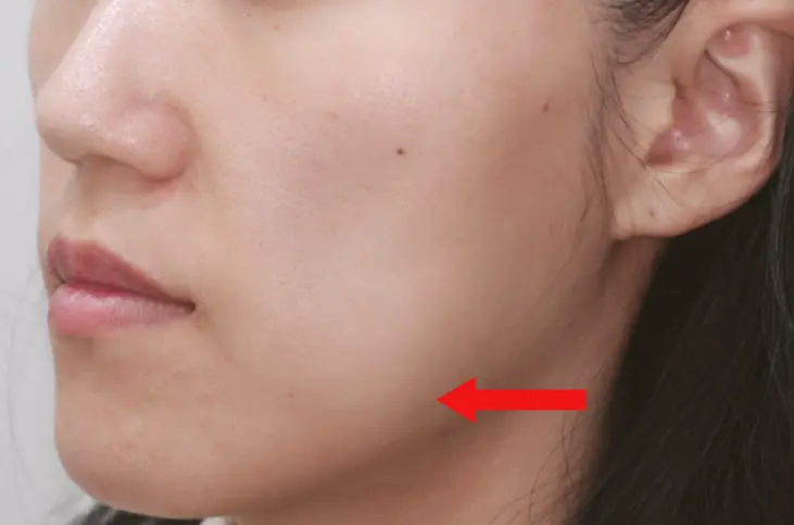 얼굴 살 없을 때 울쎄라 효과