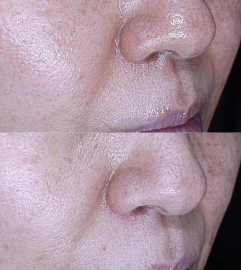 Nasolabial Fold Line and Skin Elasticity Improvement in a Patient in Their 60s After Radiesse Treatment