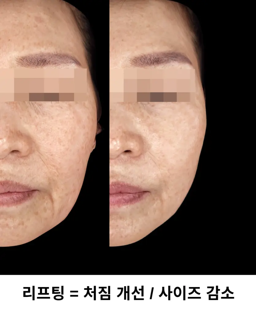 리프팅은 팔자주름, 턱선 등 처짐을 개선하는 시술입니다.
