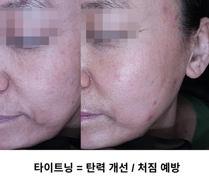 타이트닝은 피부 탄력을 개선하여, 처짐을 예방하는 시술입니다.