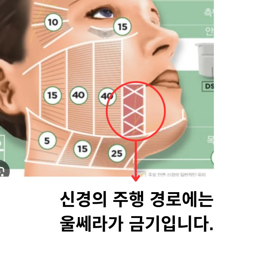 울쎄라 부작용이 발생할 수 있는 입가 부위