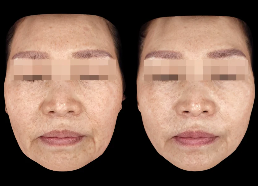 Before and After case of a woman in her 50s treated with Ultherapy