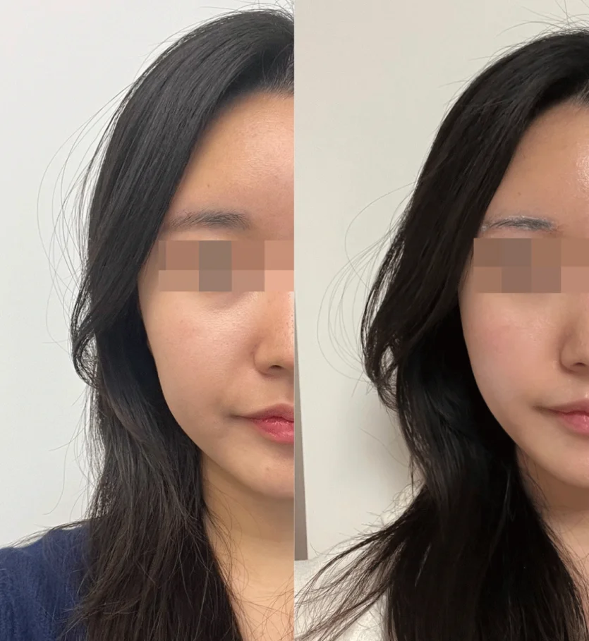 Before and After 600-Shot Ultherapy Treatment