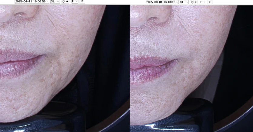 Before and After 600 shots of Thermage at ODE Clinic