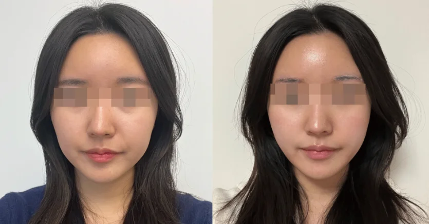 Actual Results of 600-Shot Ultherapy in a Patient in Their 20s