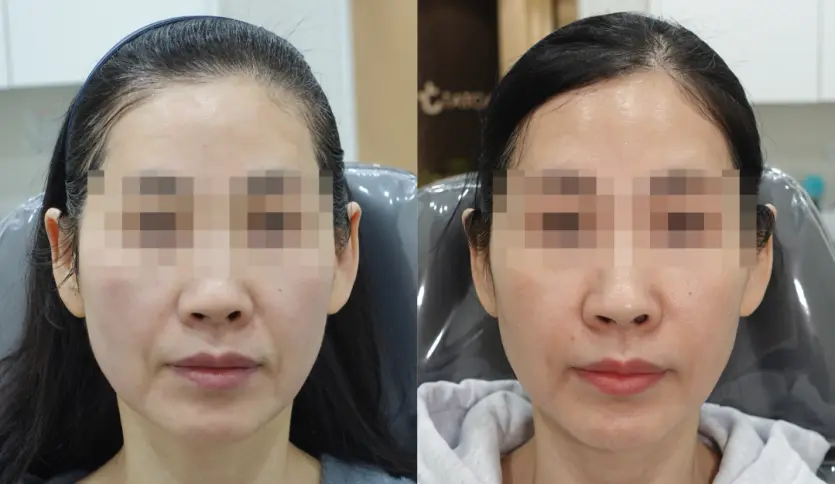 Actual ODE Clinic Radiesse Treatment Results for Nasolabial Fold Improvement