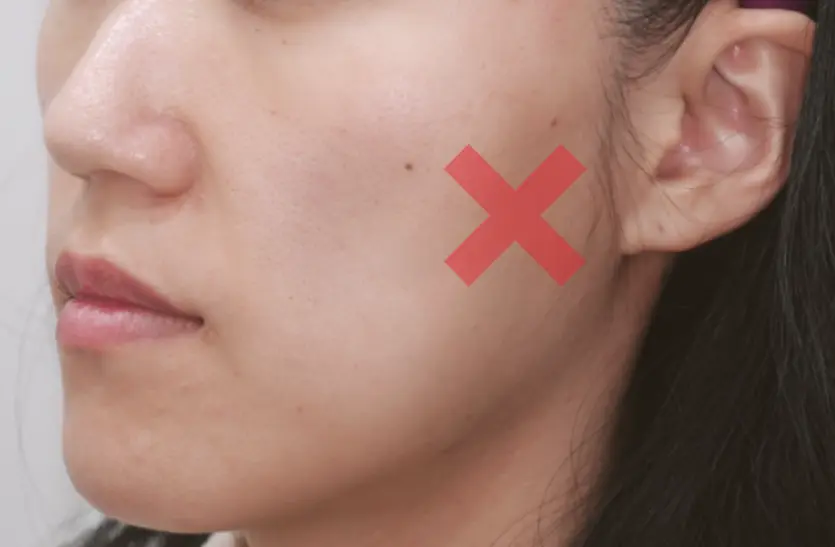 울쎄라 볼패임 부작용이 발생할 수 있는 옆볼 부위