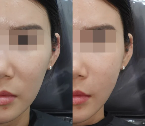 Before and After HiloWave Treatment for Nasolabial Folds