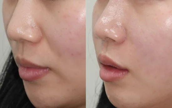 HiloWave Nasolabial Folds Treatment Effect