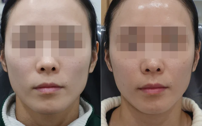 HiloWave Sunken Cheeks Treatment Effect
