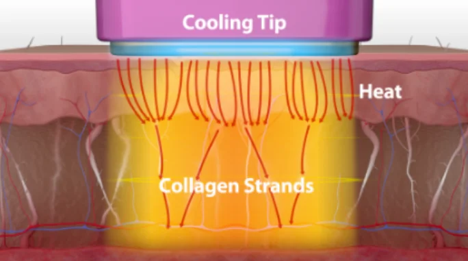 Thermage uses radiofrequency energy