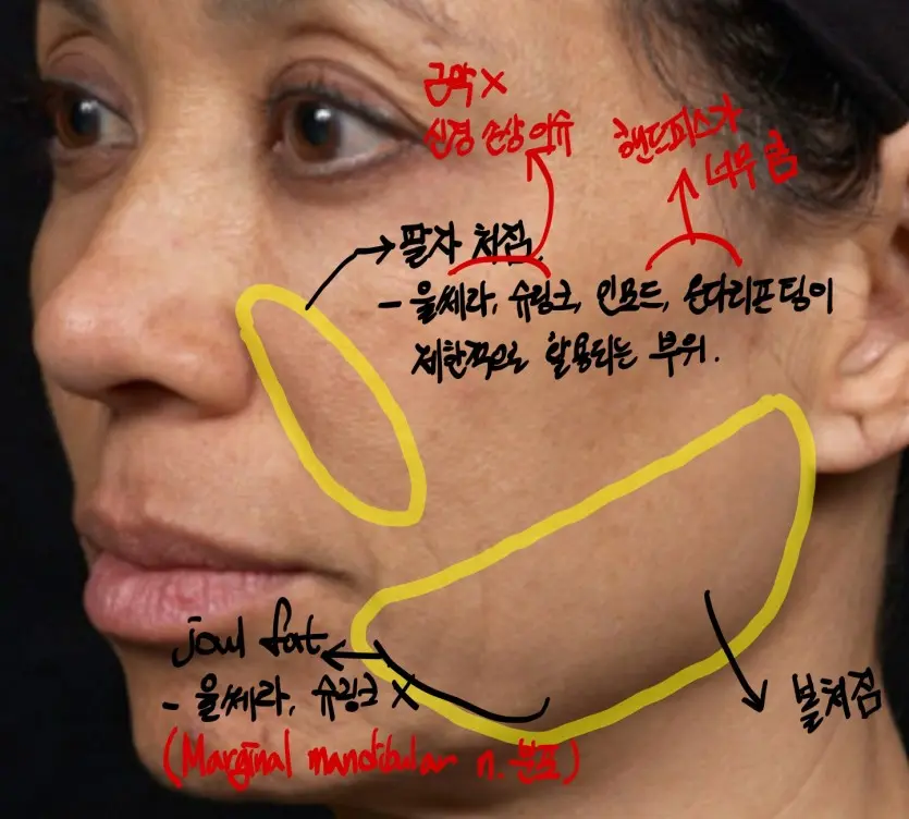 세르프 팔자주름, 심부볼 시술 범위