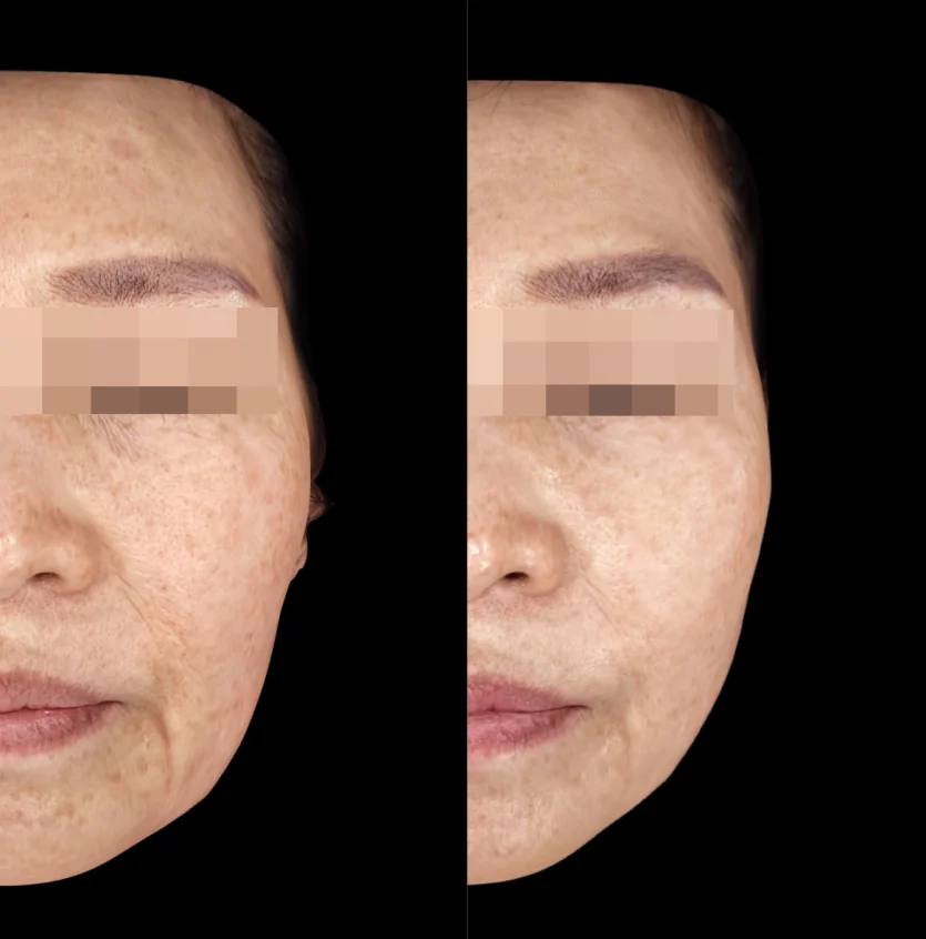 Before and After Xerf 600 shots