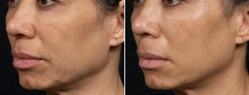 실제 써마지 전후 효과: 탄력 개선