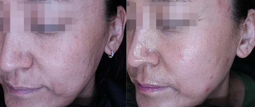 Before and After Thermage Treatment