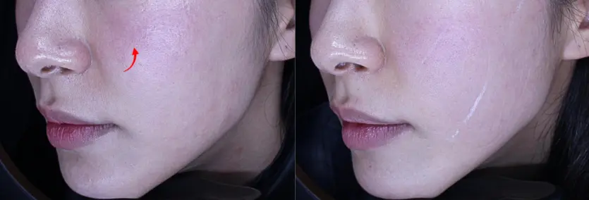 엠페이스 4회 시술 전후 비교 사진