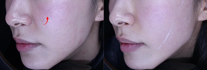 Before & After of 4 EmFace Sessions at Gangnam ODE Clinic