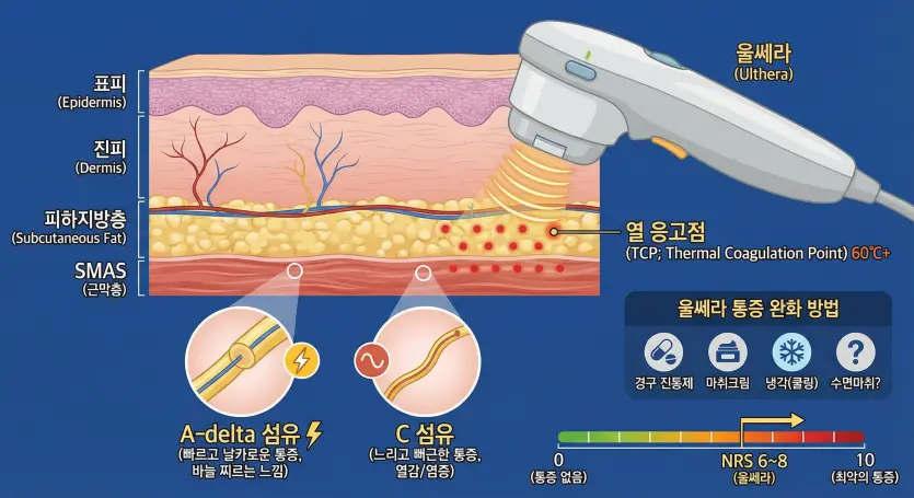Ultherapy Mechanism & Why It Causes Pain