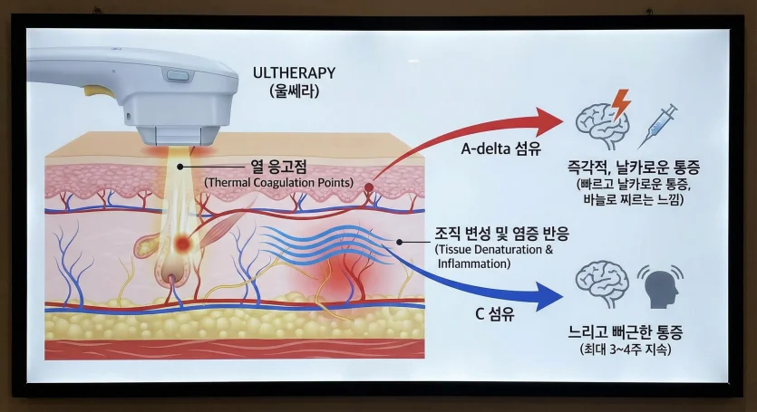 About Ultherapy Pain