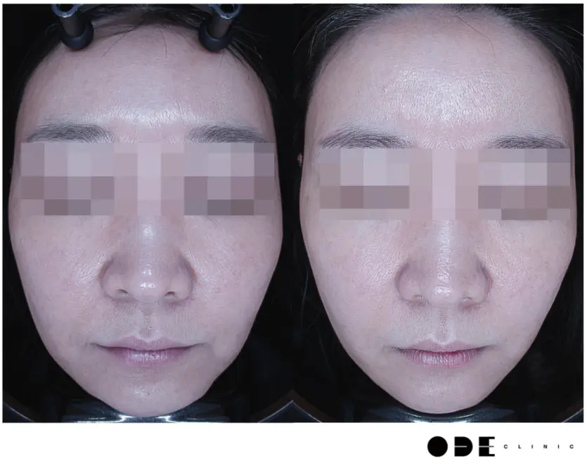 Ultherapy Before & After at Gangnam ODE Clinic