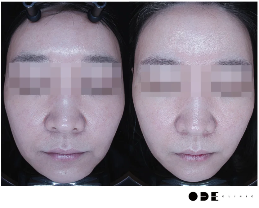 Ultherapy Before & After at Gangnam ODE Clinic