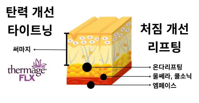 타이트닝(써마지)과 리프팅(울쎄라)의 원리 차이.