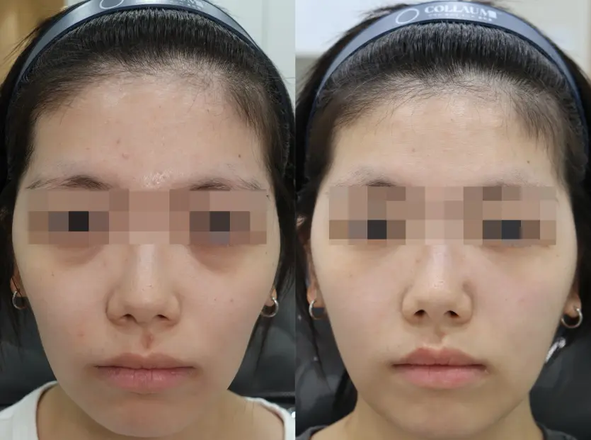 Before And After Filler,HiloWave Treatment
