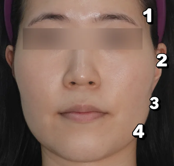 땅콩형얼굴 원인 4가지