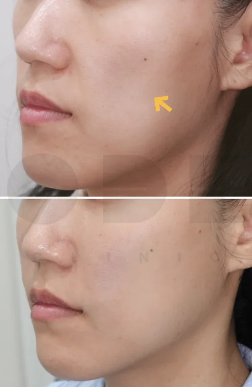 볼패임 때문에 광대, 볼처짐이 부각되는 모습