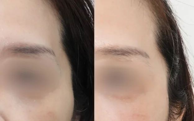 관자놀이 필러 시술 전후