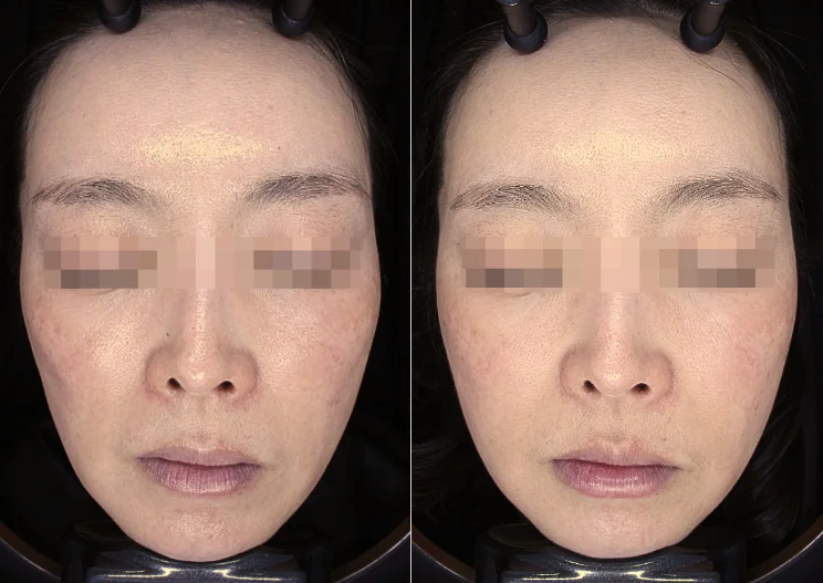 볼패임 쥬베룩볼륨 전후