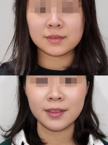 쿨소닉 시술 전후