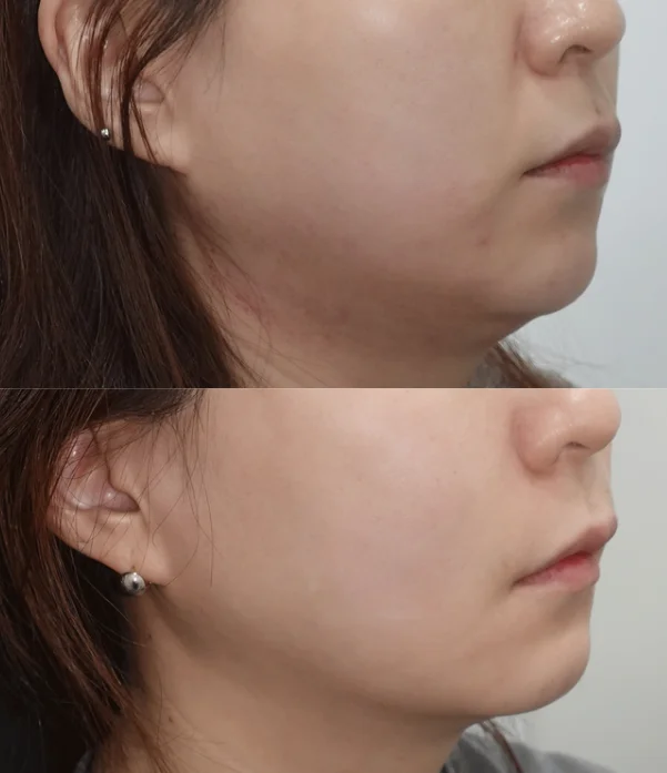 실제 쿨소닉 턱라인 및 이중턱 개선 효과