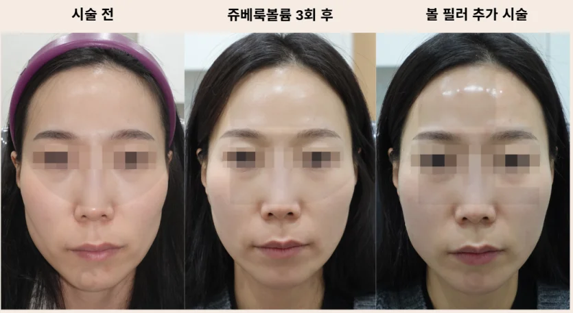 볼패임 쥬베룩볼륨 3회 후 필러 시술 사진