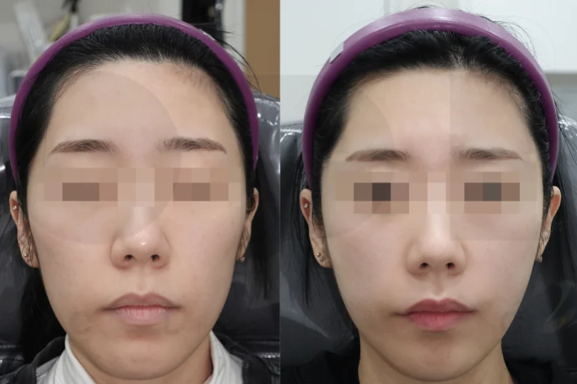 볼패임을 채우면 얼굴이 오히려 작아보이는 현상