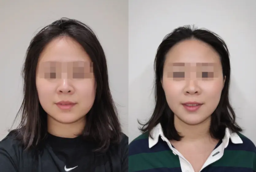 Real CoolSoniq lifting: 10,000 shots before-and-after (ODE Clinic)