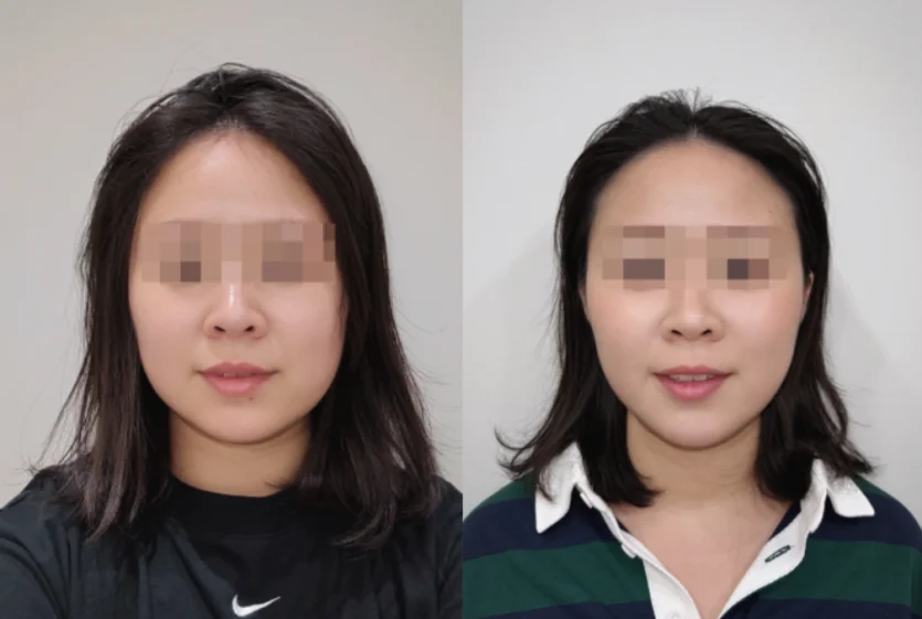 강남 쿨소닉 리프팅 시술 전후 비교 사진