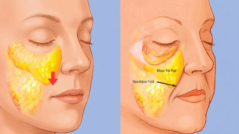 팔자주름 원인 중 malar fat pad 처짐