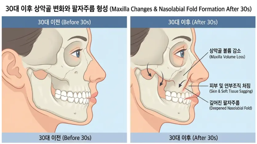 팔자주름 원인 중 상악골 뼈 흡수