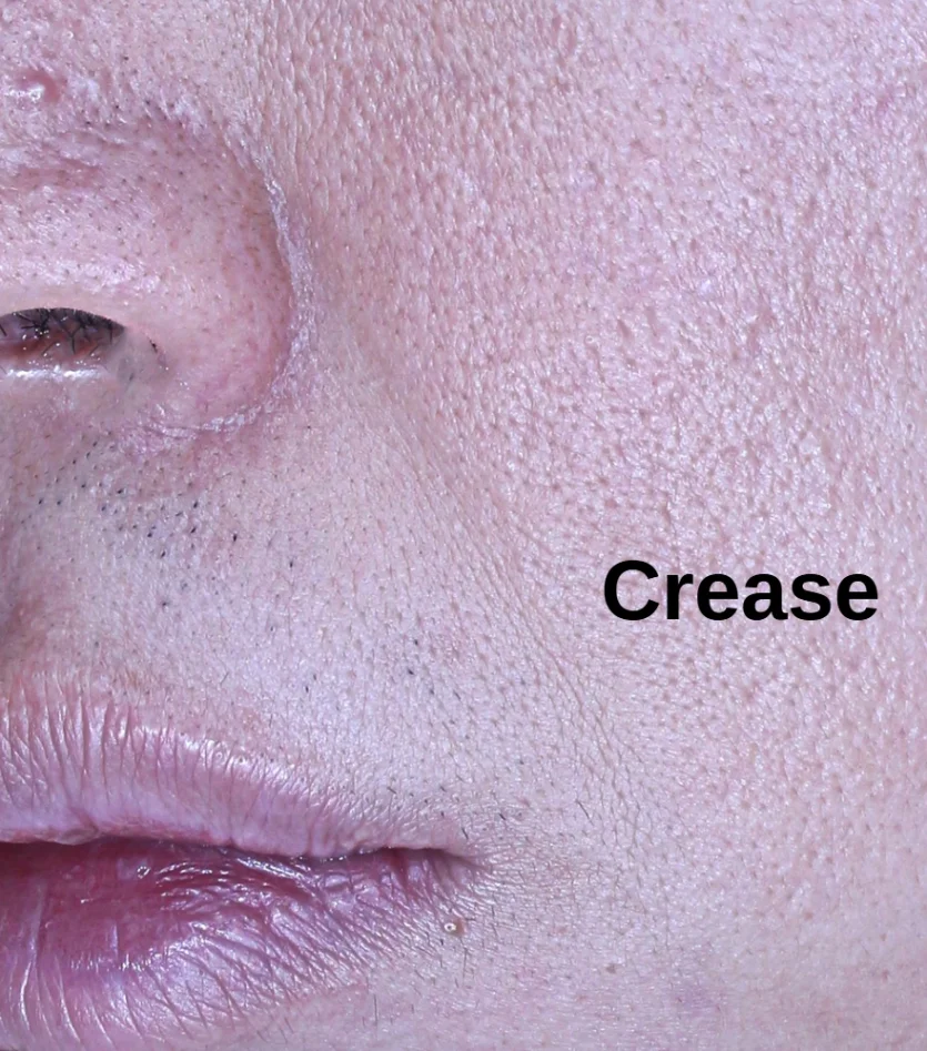 표피와 진피에 생긴 주름선 (crease)