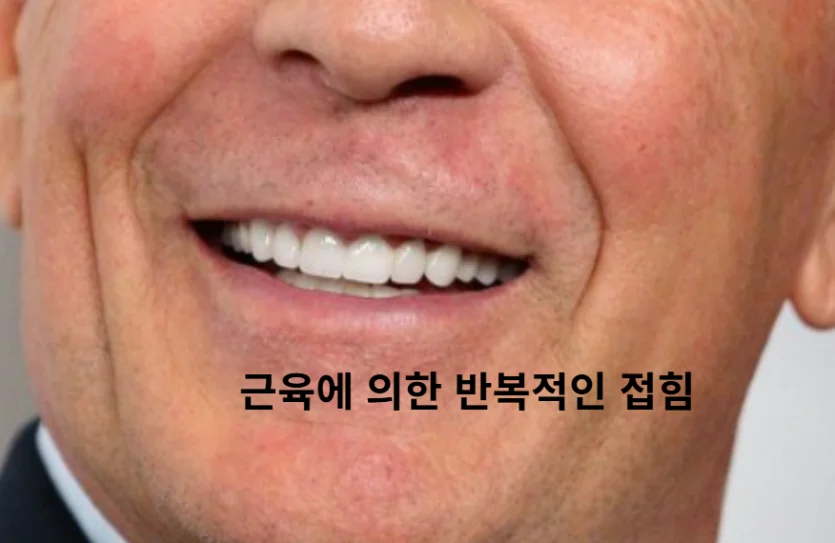 입꼬리 올림근에 의한 팔자주름 악화