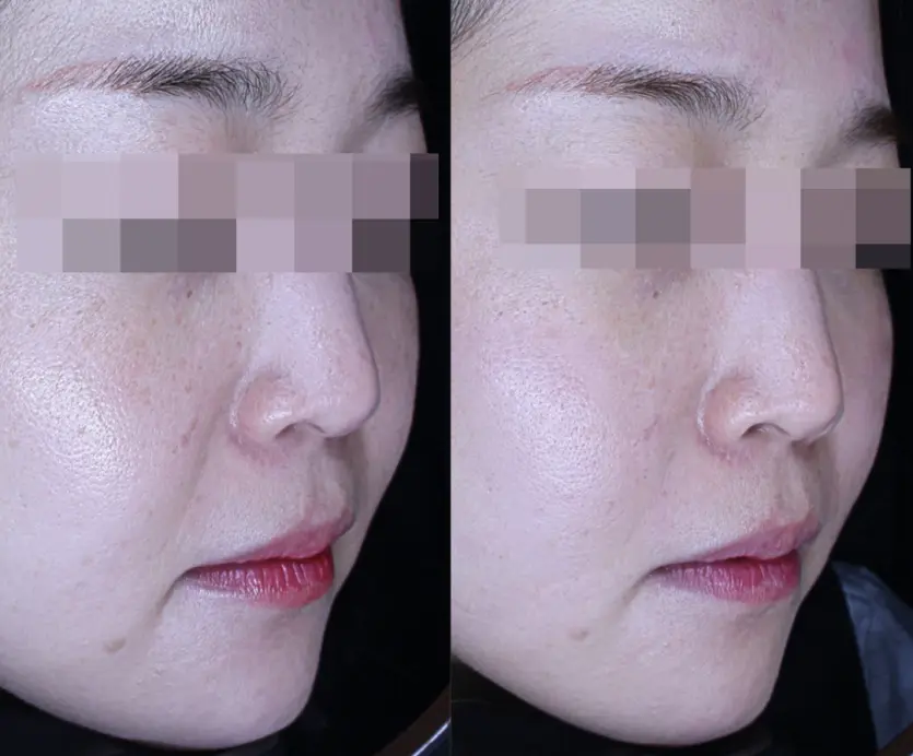 팔자주름 처짐 (malar fat pad) 개선 전후